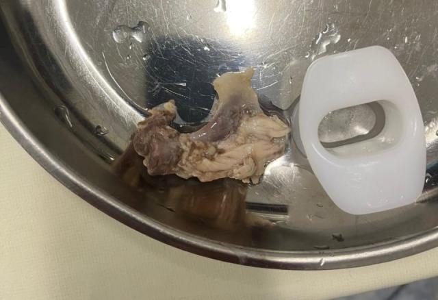 Врачи в уфимской больнице вытащили из пищевода мужчины застрявшую кость