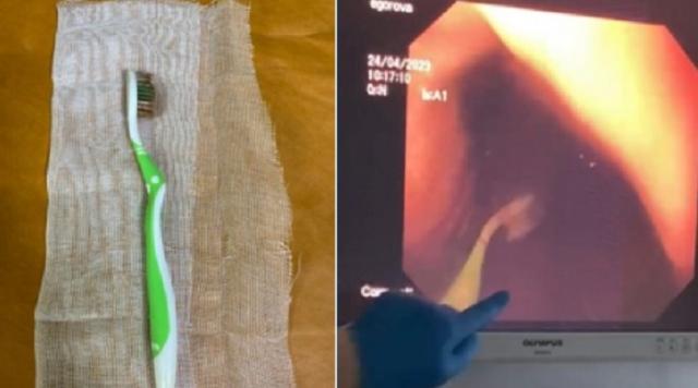 Медики извлекли из желудка пациентки в Башкирии зубную щетку 