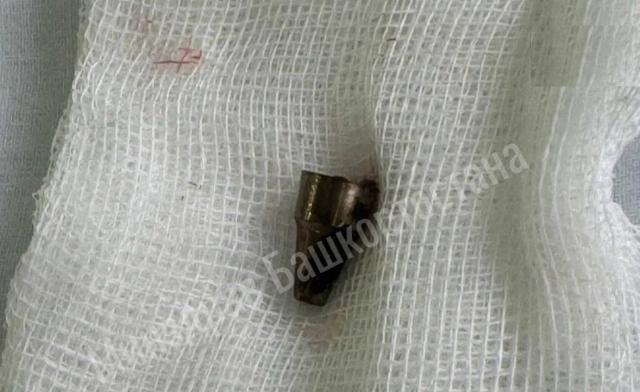 В Уфе врачи достали из уха женщины наконечник ручки