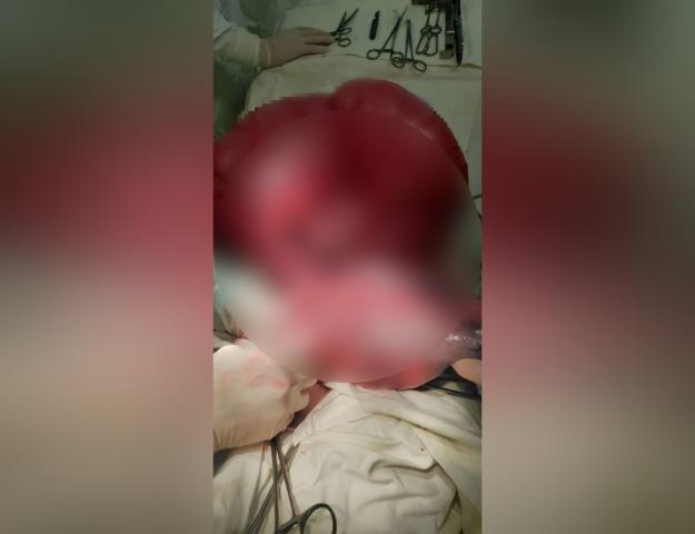 Уфимские врачи прооперировали пациента с аномально раздувшимся кишечником