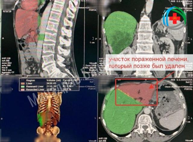 Врачи в Башкирии «нарастили» пациенту новую печень