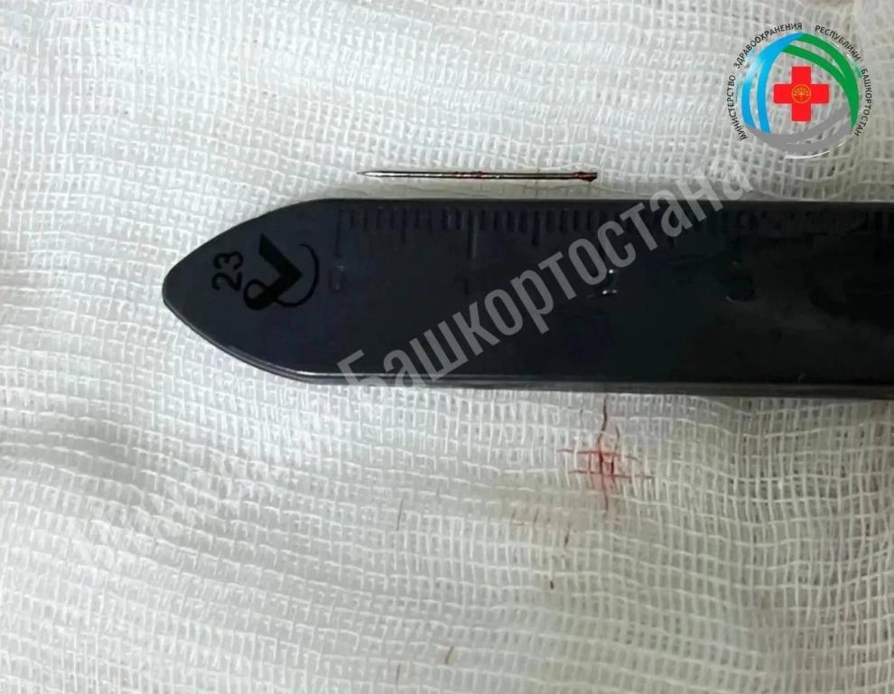 В Башкирии врачи извлекли иглу из стопы полуторагодовалого пациента