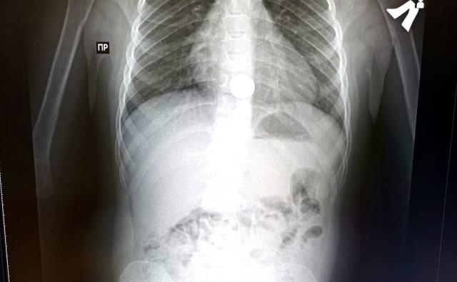 В Башкирии 5-летний ребенок был госпитализирован из-за монеты в пищеводе