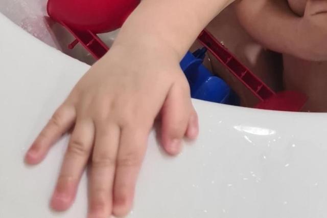 В Уфе прооперировали грудного ребенка с шестью пальцами на руке
